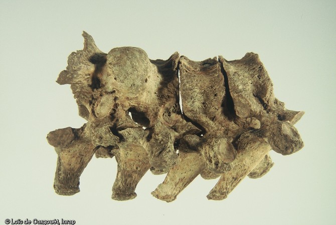 L'étude ostéologique sur les squelettes de la nécropole mérovongienne de Ligny-le-Châtel (Yonne) fouillée en 2005. Ici constatations de vertèbres soudées.