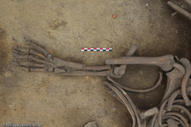 Détail de la fosse 124 sur le site néolithique d'Achenheim (Bas-Rhin), 2016. Un membre supérieur présente plusieurs fractures au niveau du bras et de l'avant-bras. Cette fosse est un vaste silo de près de 2,5 m de diamètre dans lequel ont été abandonnés six individus présentant tous des traces de nombreuses fractures. Ce dépôt de cadavres est constitué en un temps, et évoque une même tuerie, un même conflit.