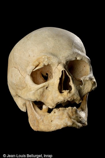 Crâne du VIIIe-IXe siècle, mis au jour dans une tombe à Noisy-le-Grand (Seine-Saint-Denis). Au niveau de l'arcade sourcilière droite, un petit bout d'os a été arraché, coupé et s'est en partie ressoudé au reste du crâne.