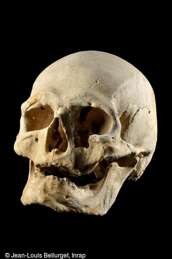 Crâne du VIIIe-IXe siècle, mis au jour dans une tombe à Noisy-le-Grand (Seine-Saint-Denis). Au niveau de l'arcade sourcilière droite, un petit bout d'os a été arraché, coupé et s'est en partie ressoudé au reste du crâne.