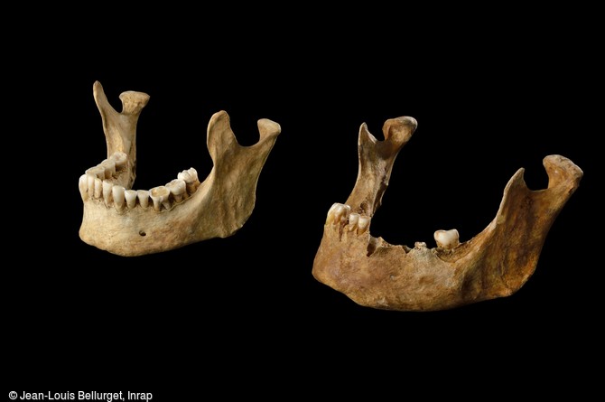 Mandibules saine (à gauche) et malsaine (à droite), VIIIe-IXe siècle,  découvertes dans une tombe à Noisy-le-Grand (Seine-Saint-Denis). Exceptées quelques caries et perte de dents, l'hygiène de la bouche était correcte, et les dents plutôt saines. 