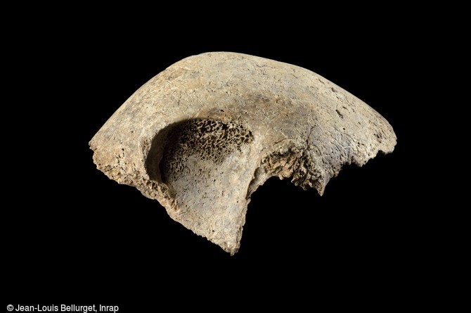 Os frontal mis au jour dans une tombe du VIIIe-IXe siècle, à Noisy-le-Grand (Seine-Saint-Denis). La voûte orbitaire présente une petite zone criblée, provenant de carences alimentaires ou d'une maladie durant l'enfance. 