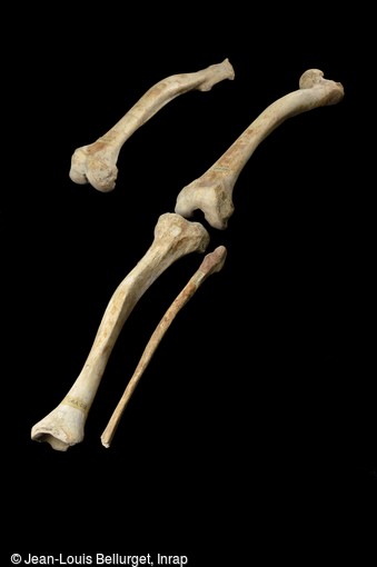 Péroné, tibia et fémur découverts dans le cimetière médiéval de Villemomble (Seine-Saint-Denis). Ces os de ce membre inférieur gauche d'un individu du IXe-Xe siècle, présentent une courbure anormale due au rachitisme. 