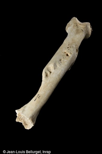 Fémur droit avec fracture, IXe-Xe siècle,  découvert dans le cimetière médiéval de Villemomble (Seine-Saint-Denis). Cet os présente une impressionnante fracture. L'individu n'a pas été immobilisé à la suite de ce traumatisme. Un cal osseux s'est alors formé pour relier les deux fragments d'os entre eux.