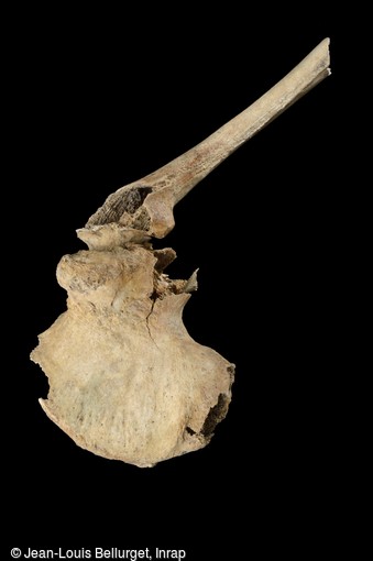 Fémur et os du bassin, IXe-Xe siècle, découvert dans le cimetière médiéval de Villemomble (Seine-Saint-Denis). L'activité, l'âge et de mauvaises habitudes ont provoqué une ossification de ces deux os entre eux. cet individu avait du mal à marcher.