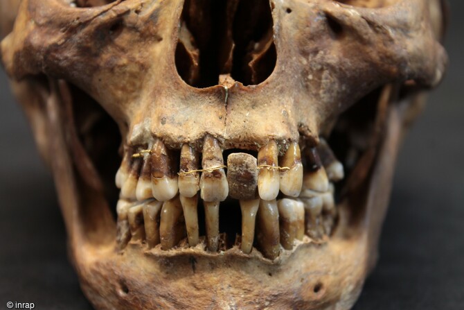  Crâne d'Anne d'Alègre, comtesse de Laval (1565-1619), équipée de prothèses dentaires aux fils d'or, dont le squelette à été découvert à Laval (Mayenne), en 1988.  Collection Musée de Laval.  