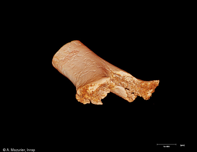 Reconstitution microtomographique en 3 D de l'humérus de l'amputé néolithique de Buthiers-Boulancourt (Seine-et-Marne), 2005.  