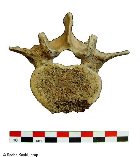 Lésion ostéolytique de la 4e vertèbre lombaire d'un jeune adulte masculin mis au jour à Marck-en-Calaisis (Pas-de-Calais).La localisation de ce foyer érosif à la marge supéro-antérieure du corps vertébral est évocatrice d'une possible brucellose, également appelée  fièvre de Malte .  Photo publiée dans le numéro 35 de la revue de l'Inrap Archéopages.
