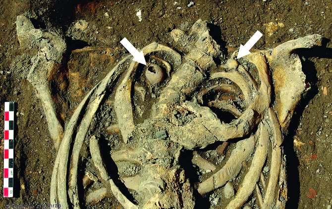 Calcifications(XVe-XVIIe s.) mises au jour dans la cavité thoracique d'un individu inhumé dans le cimetière paroissial attenant à la basilique Notre-Dame à Boulogne-sur-Mer (Pas-de-Calais), 2012.  